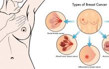 How to identify breast cancer in women: symptoms and causes